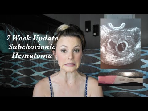 Surrogate Pregnancy #2  Subchorionic Hematoma 7 Weeks Pregnancy Update