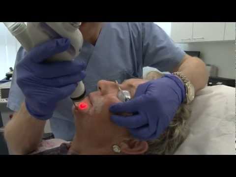 Faltenbehandlung mit dem fraktionierten CO2 Laser