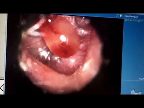 download lagu mp3 mp4 Blister In Ear, download lagu Blister In Ear gratis, unduh video klip Blister In Ear