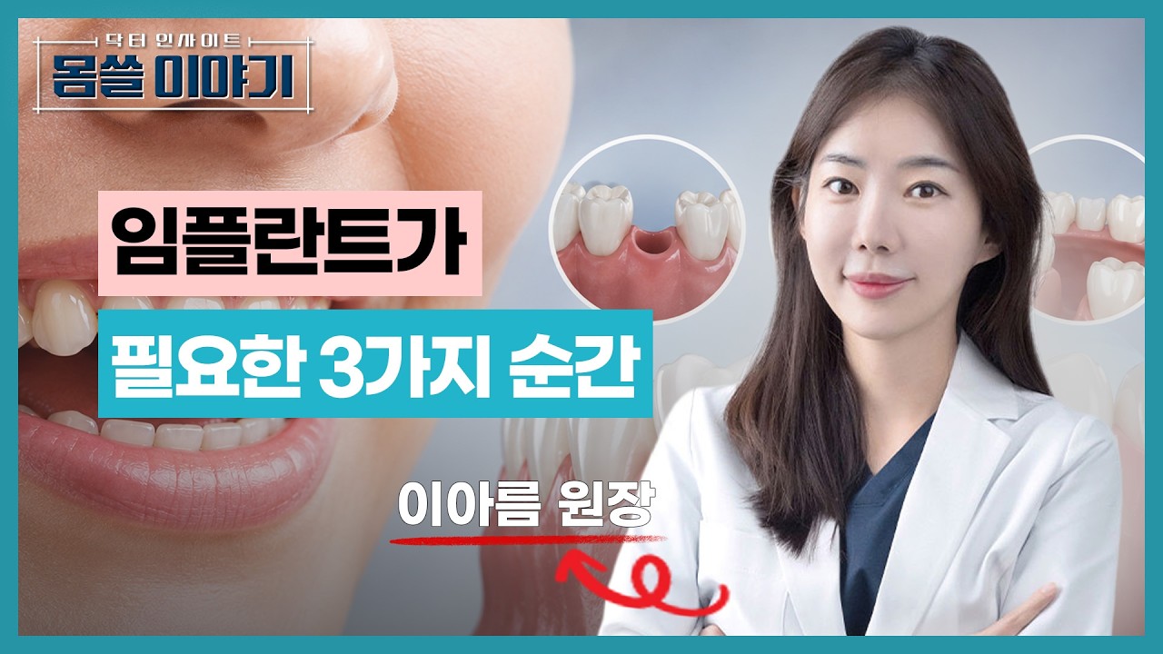 치아 빠졌다면 방치하지 마세요…임플란트가 필요한 3가지 경우 [몸쓸이야기 30회]
