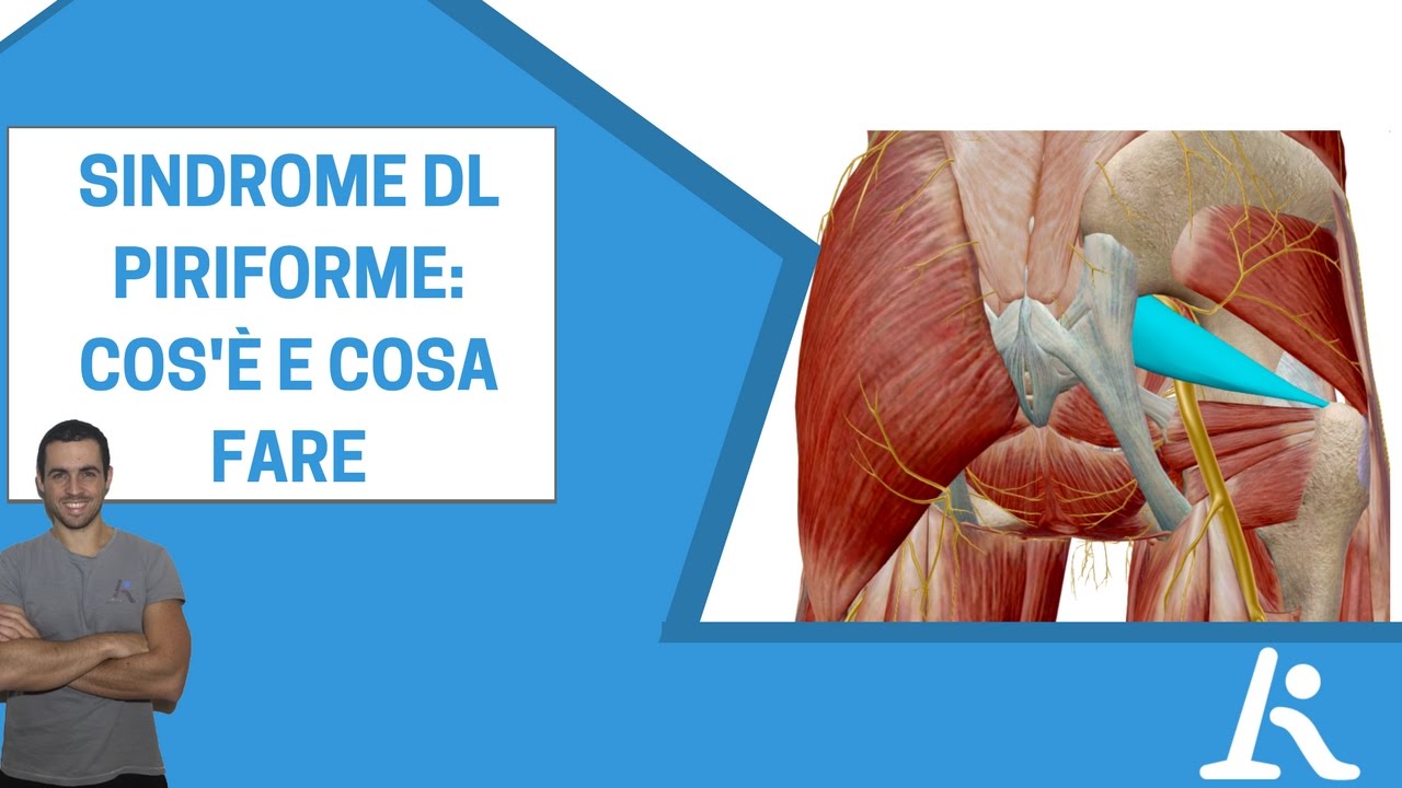 Watch Now Sindrome del piriforme: cos'è e come si cura Sindrome del piriforme: cos'è e come si cura