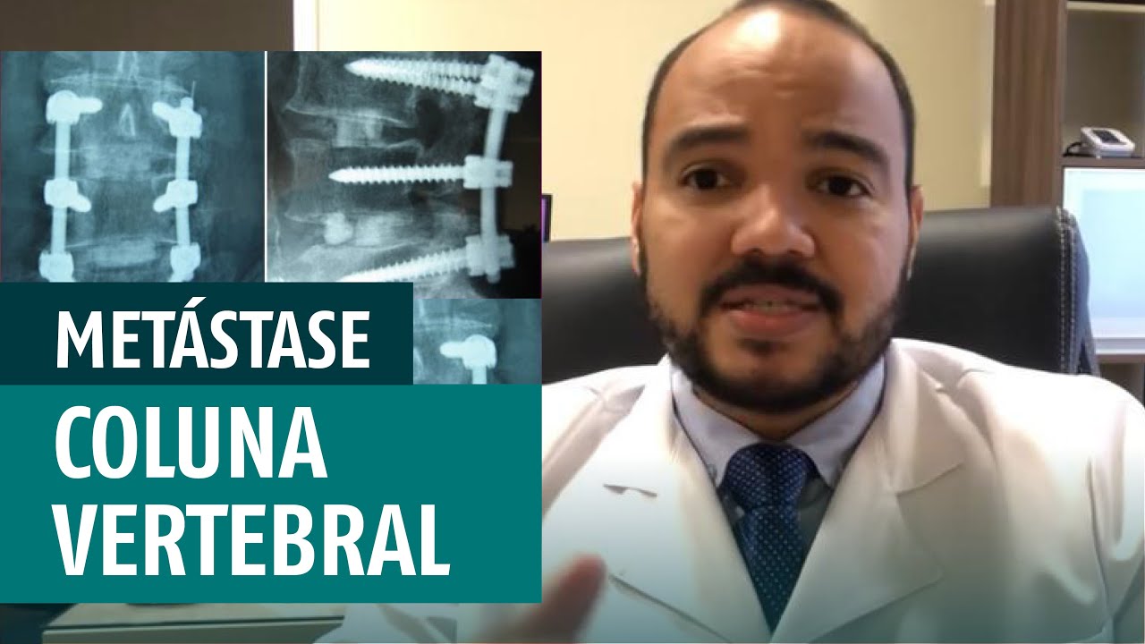 Metástase da Coluna Vertebral tem cura Devo operar ou não