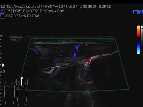 Esercizi con lussazione dellarticolazione del gomito con il video Ernia discale dei sintomi della colonna cervicale e trattamento