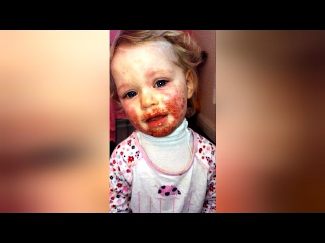 У ребенка 8 месяцев были страшные кровоподтеки на лице. Когда мама обнаружила причину — была в ужасе