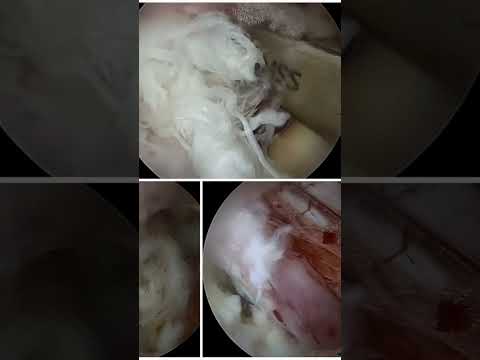 Spine Endoscopy Surgery : How is it done स्पाइन एंडोस्कोपी सर्जरी: यह कैसे की जाती है?