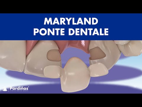 MARYLAND DENTI - UN PONTE DENTALE alternativo per i denti mancanti ©