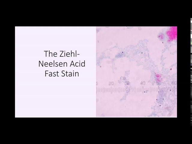 Video Pronunciation of ziehl-neelsen in English Video Pronunciation of ziehl-neelsen in English