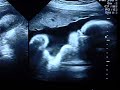 Ultrasound Week 30 Video