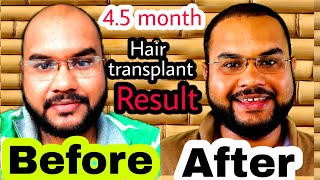 Hair transplant result 4.5 month completed (Hair transplant 2018)|| law of gratitude || #tannudada