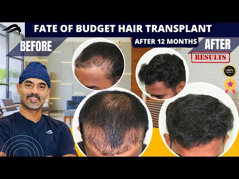 Hair Transplant In Bangalore | Best Results Surgeon...