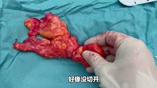 看起来很小，居然挖出来一个巨大的肿瘤！来看医生挖肿瘤！