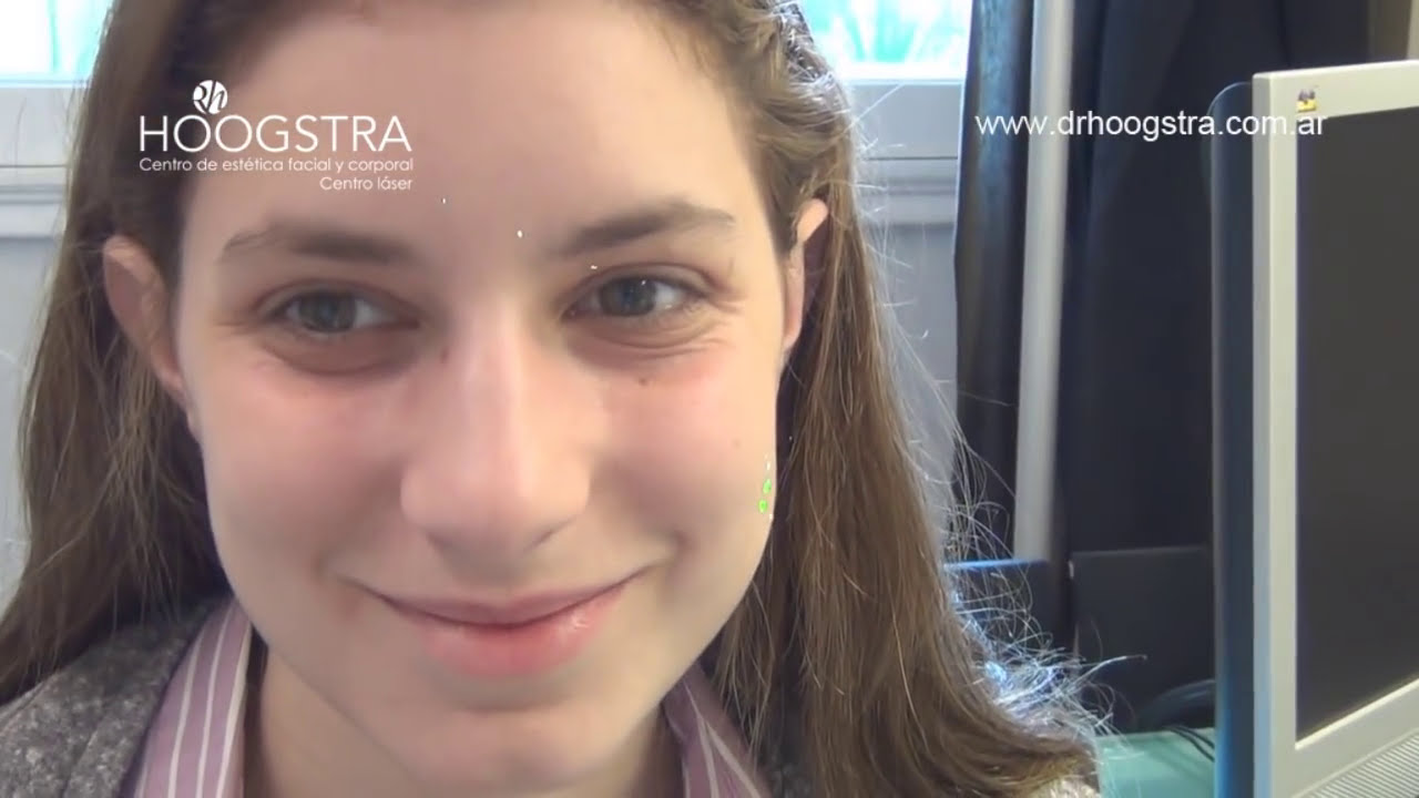 ¿Cómo eliminar las Ojeras Tratamiento Láser con Co2 (13002)