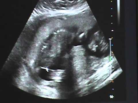 Ultraljud i vecka 20. 19+4. 11-02-14