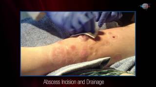 WCW: Abscess Incision and Drainage