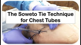 The Soweto Tie for Chest Tubes