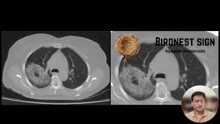 Mucormycosis   Birdnest sign #Mucormycosis#BirdNestSign #RhinocerebralMucormycosis #Radiology