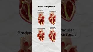 Download lagu Aritmia, Detak Jantung Tidak Teratur mp3