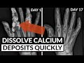 Reverse Soft Tissue Calcification: Bring Calcium Out Of Tissue & Into Bones