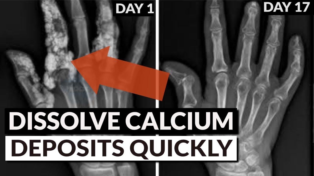 Reverse Soft Tissue Calcification: Bring Calcium Out Of Tissue & Into Bones