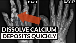 Reverse Soft Tissue Calcification: Bring Calcium Out Of Tissue & Into Bones