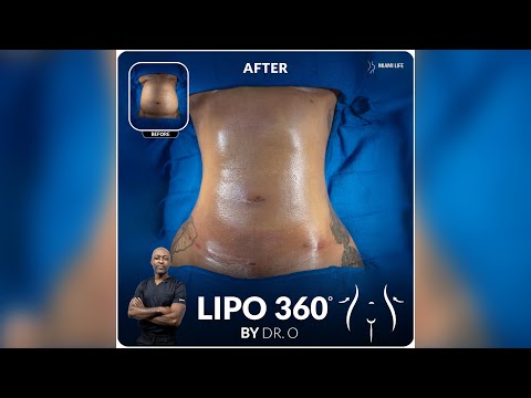 Lipo 360 Results By Dr.Oneyka Nwokocha - Miami Life Cosmetic Center
