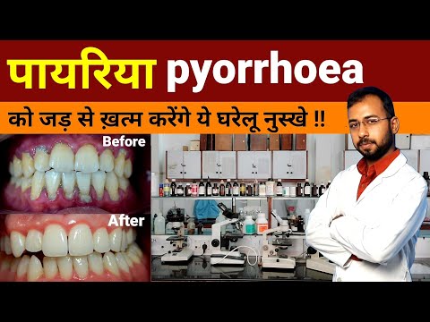 Pyorrhea ka gharelu ilaj | pyorrhea treatment at home | Periodontitis Treatment | pyorrhea symptoms