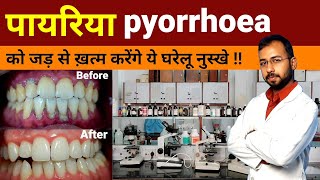 Pyorrhea ka gharelu ilaj | pyorrhea treatment at home | Periodontitis Treatment | pyorrhea symptoms
