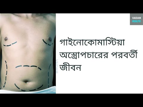 গাইনোকমাস্টিয়া অস্ত্রোপচারের পরবর্তী জীবন