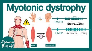 Myotonic Dystrophy | signs and symptoms, pathophysiology, treatment of Myotonic Dystrophy