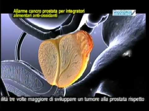 Una bevanda antidolorifico con prostatite Che ha curato una cisti nella prostata
