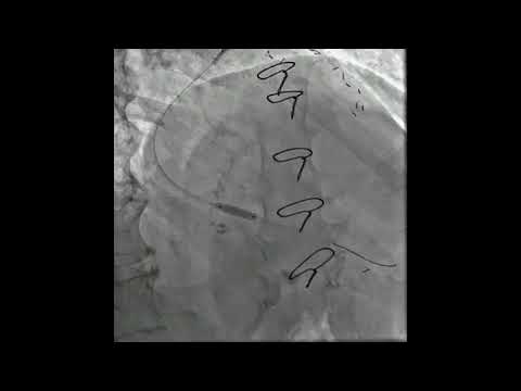 MV PCI POST CABG PATIENT