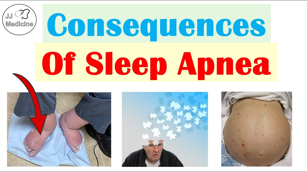 Consequences of Sleep Apnea | Cognitive Dysfunction, Depression, Heart Disease & More