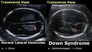 Fetal Ultrasound Normal Vs Down Syndrome | Soft Markers In Fetus For Trisomy 21 | Aneuploidies USG