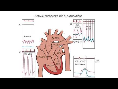 Right Heart Catheterization  - an introduction