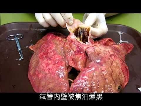 Impotensi prostatitis Pengobatan impotensi YouTube