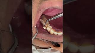 tooth fracture #broken #tooth#fyp #video #foryou #tiktok #viral #tiktok #trending #love #foryou