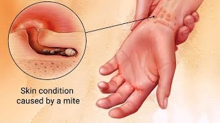 Causes Symptoms and Treatment of Scabies