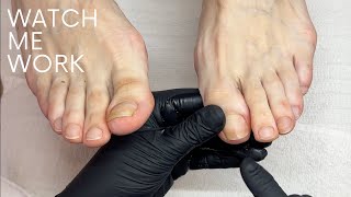 Pedicuring toenails with micro trauma damage (follow up #3)