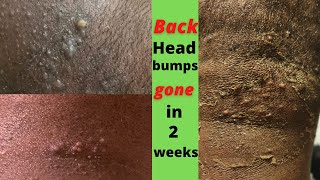 Back head bumps quickest transformation/Razor bumps gone/(Acne keloidalis)