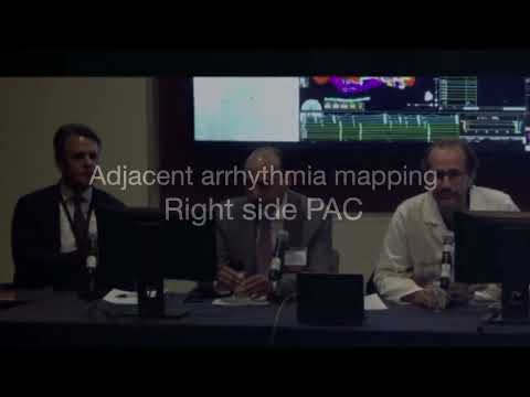 Live Procedure: Redo Afib Ablation Live Procedure (EP Live 2022)