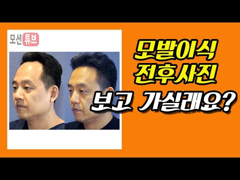 비절개 전문 모션의원 only FUE MOTION CLINIC before & after