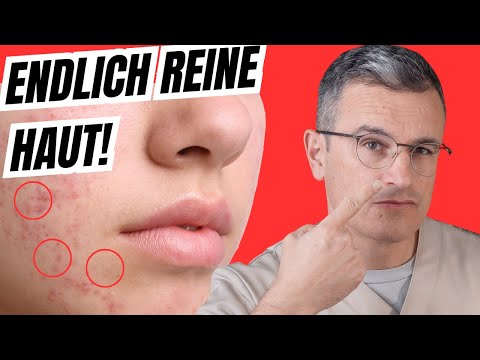 Akne behandeln: Ursachen verstehen & moderne Therapien 💊✨