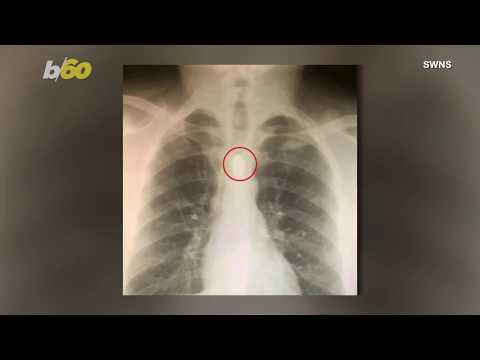Party Trick Gone Awry! Man Swallows This Object, Only to Get It Stuck in His Throat