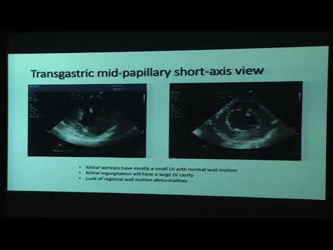 20180824_24_Mitral_stenosis_and_Mitral_regurgitation_(case-based_TEE evaluation)_ Rajesh_Arya_Dr