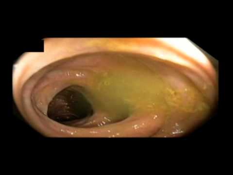 Diverticulosis sigmoidea - 2