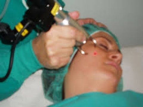 La decolorazione di creme del prezzo Come liberarsi nella primavera di pigmentary nota su una faccia