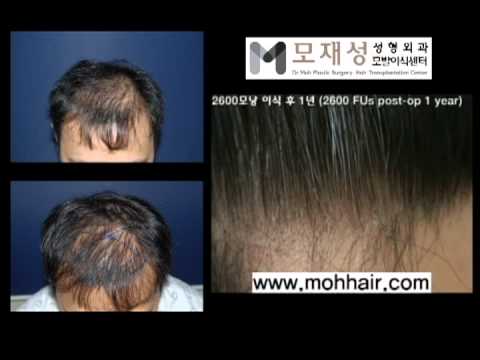 2600FU's. FUE Hair Transplant by Dr. Moh