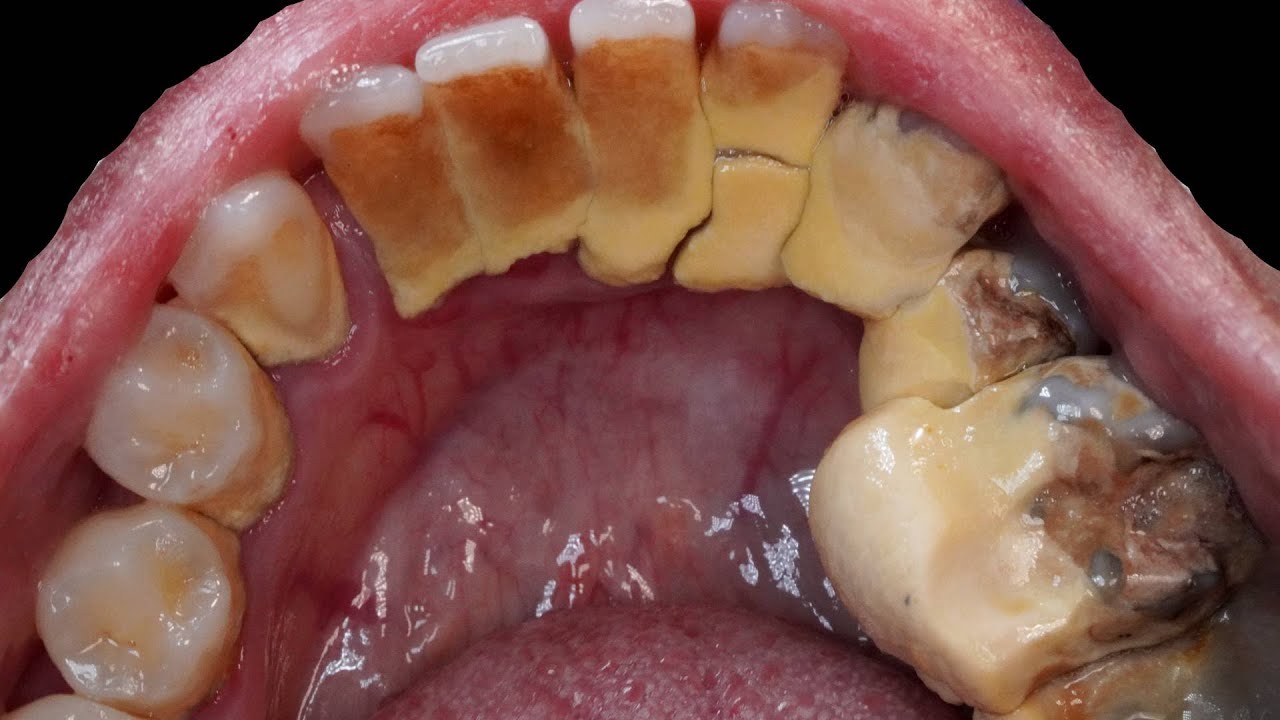 Do U Want A Longer Video? Here U Go! Scaling&Tooth Extraction | 28yo Female | Dokter Gigi Tri Putra