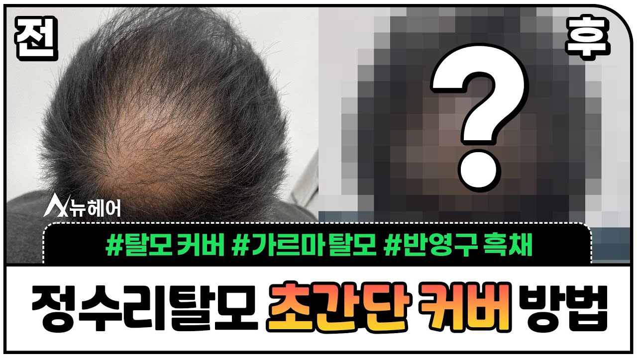 정수리탈모 초간단 커버방법! 매일 뿌릴 필요 없는 흑채!? ㅣ뉴헤어