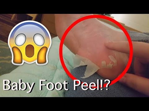 Baby Foot Peel Review! WARNING: FEET HATERS LOOK AWAY!